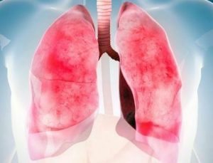 Akciğer Sağlığınızı Korumak İçin 5 Önemli Adım: Bilim İnsanlarından Öneriler